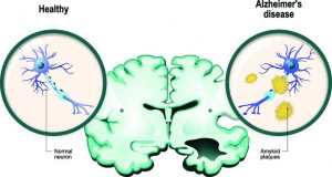 Alzheimer's Brain